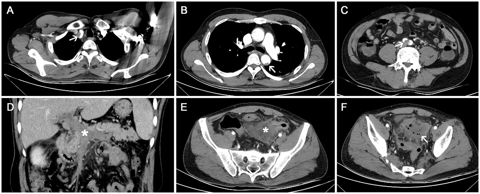 Six-panel CT scan images labeled A to F show different cross-sectional views of a human body. Panels A, B, and C display various thoracic and abdominal areas with arrows indicating specific points of interest. Panels D, E, and F highlight other regions, with asterisks marking certain areas.