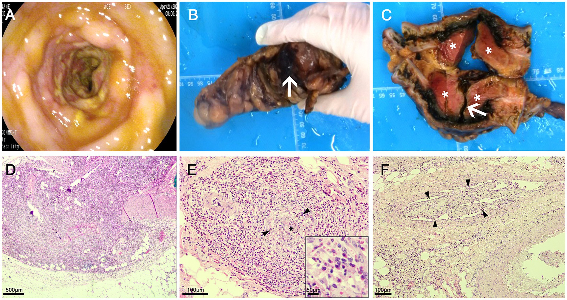 A series of medical images: A) Endoscopic view showing the lining of a hollow organ. B) Excised specimen with an irregular mass indicated by an arrow. C) Opened specimen with multiple dark lesions marked by asterisks and an arrow. D) Histological slide with tissue structure visible, scale 500 micrometers. E) Histology showing a dense cellular area with an asterisk and arrows pointing to specific features, scale 100 micrometers, inset scale 50 micrometers. F) Histological slide with elongated structures marked by arrowheads, scale 100 micrometers.