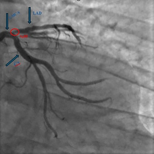 Coronary angiogram showing blood vessels with labels for different arteries: left anterior descending artery (LAD) and circumflex artery (LCx). A red circle highlights an area with the percentage 70% noted, indicating stenosis or narrowing.