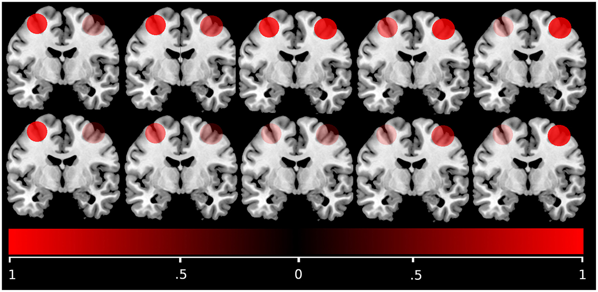 A schematic figure of brains depicting scenarios of bilateral activation and corresponding laterality index values. A great discrepancy between activation in a brain area between both hemispheres corresponds to a high laterality index (maximum 1). A low discrepancy corresponds to a low laterality index (minimum 0).