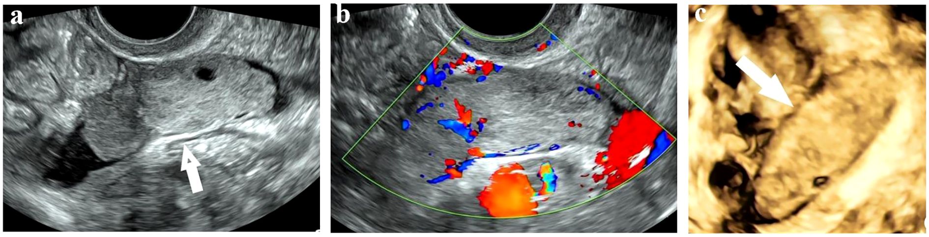 Three ultrasound images labeled a, b, and c. Image a shows a grayscale ultrasound with an arrow pointing to a structure. Image b includes color Doppler overlays in red and blue, indicating blood flow. Image c is a 3D ultrasound showing a highlighted area with an arrow.