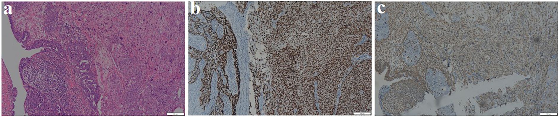 Histological images of tissue samples, labeled a, b, and c. Image a shows a purple-stained tissue section. Image b displays tissue with dark brown staining, indicating positive immunohistochemical staining. Image c shows lighter staining scattered within the tissue. Each image includes a scale bar for reference.