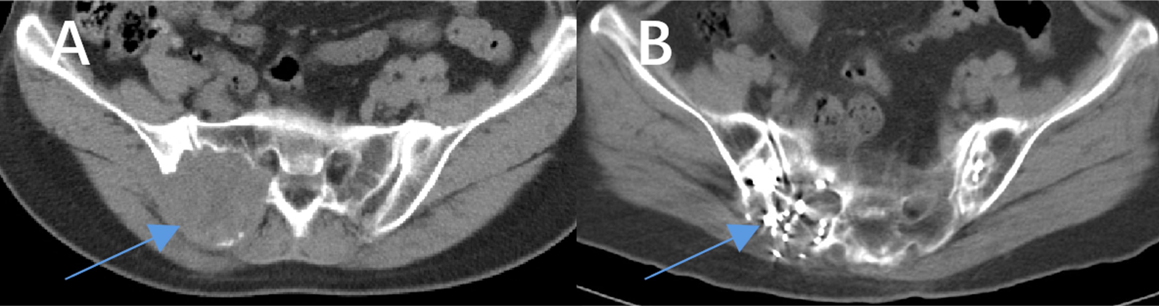 CT scan images labeled A and B showing different sections of the pelvic region with arrows indicating specific areas. Image A highlights a region with denser soft tissue, while image B shows a more calcified or highlighted area.