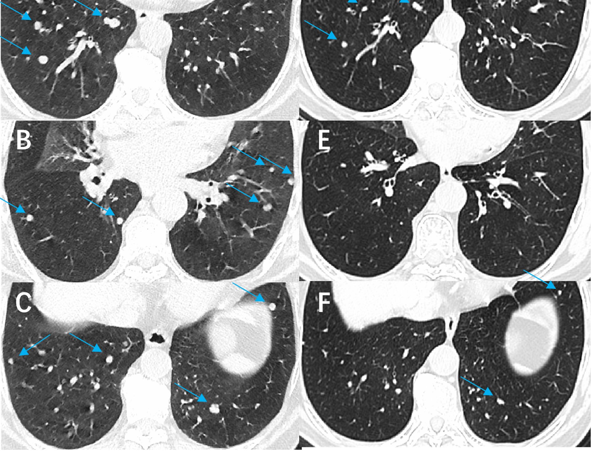 CT scan images of lungs labeled A to F, showing various lung nodules and abnormalities indicated by blue arrows. Each image highlights different regions and nodules, illustrating abnormal patterns throughout the lungs.