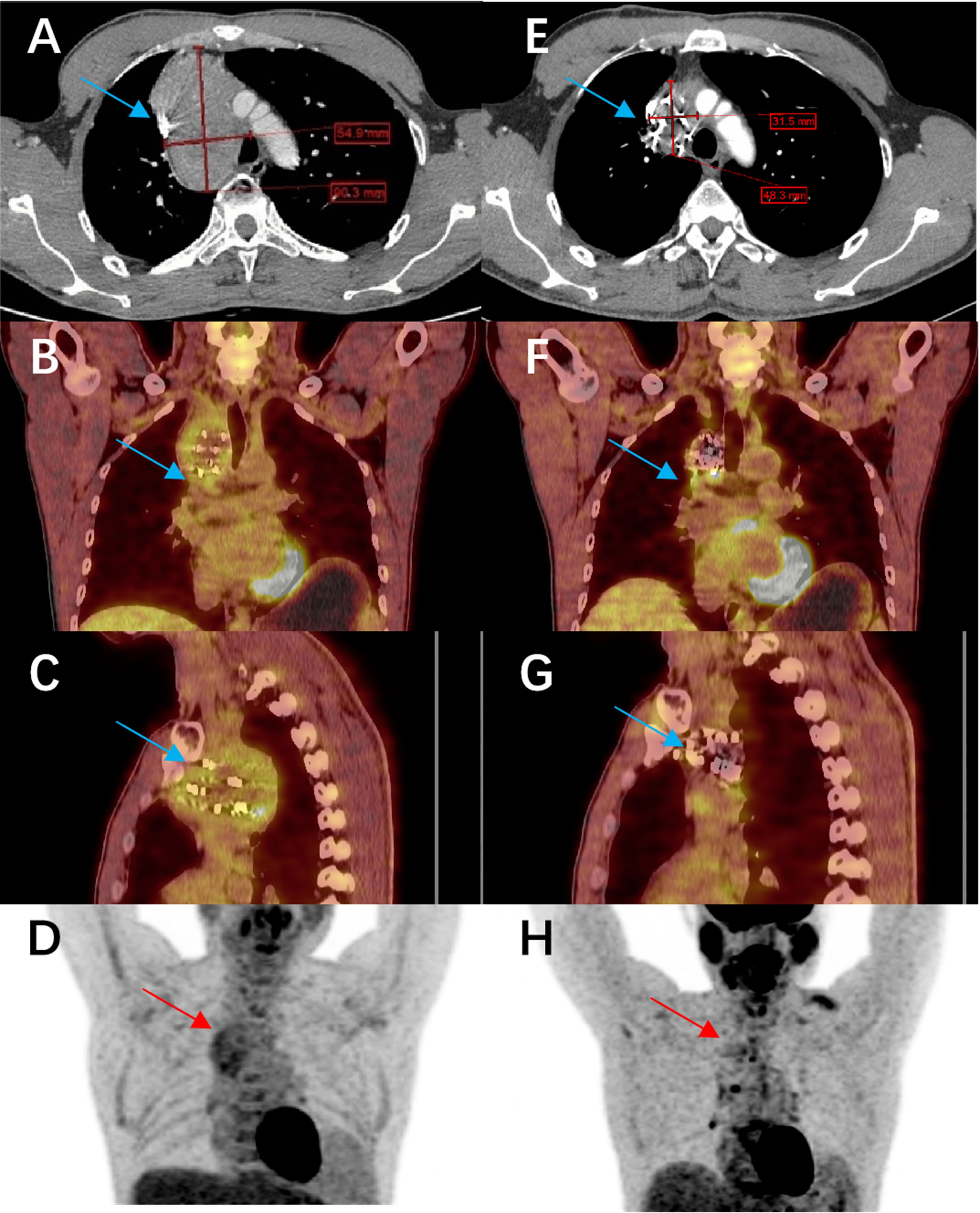 CT and PET scans display a mass in the chest region. Panels A and E show axial CT views with measurements annotated in red. Panels B, C, F, and G highlight coronal and sagittal views, with the mass marked by blue arrows. Panels D and H present grayscale PET scans with red arrows indicating areas of interest in the chest.