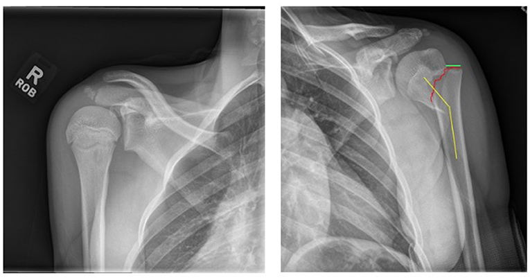 X-ray of a right shoulder showing a fracture. The first image displays a clear view of the shoulder joint. The second image includes lines indicating the direction of the fracture: a vertical yellow line, a horizontal green line, and a red zigzag line over the fracture site.