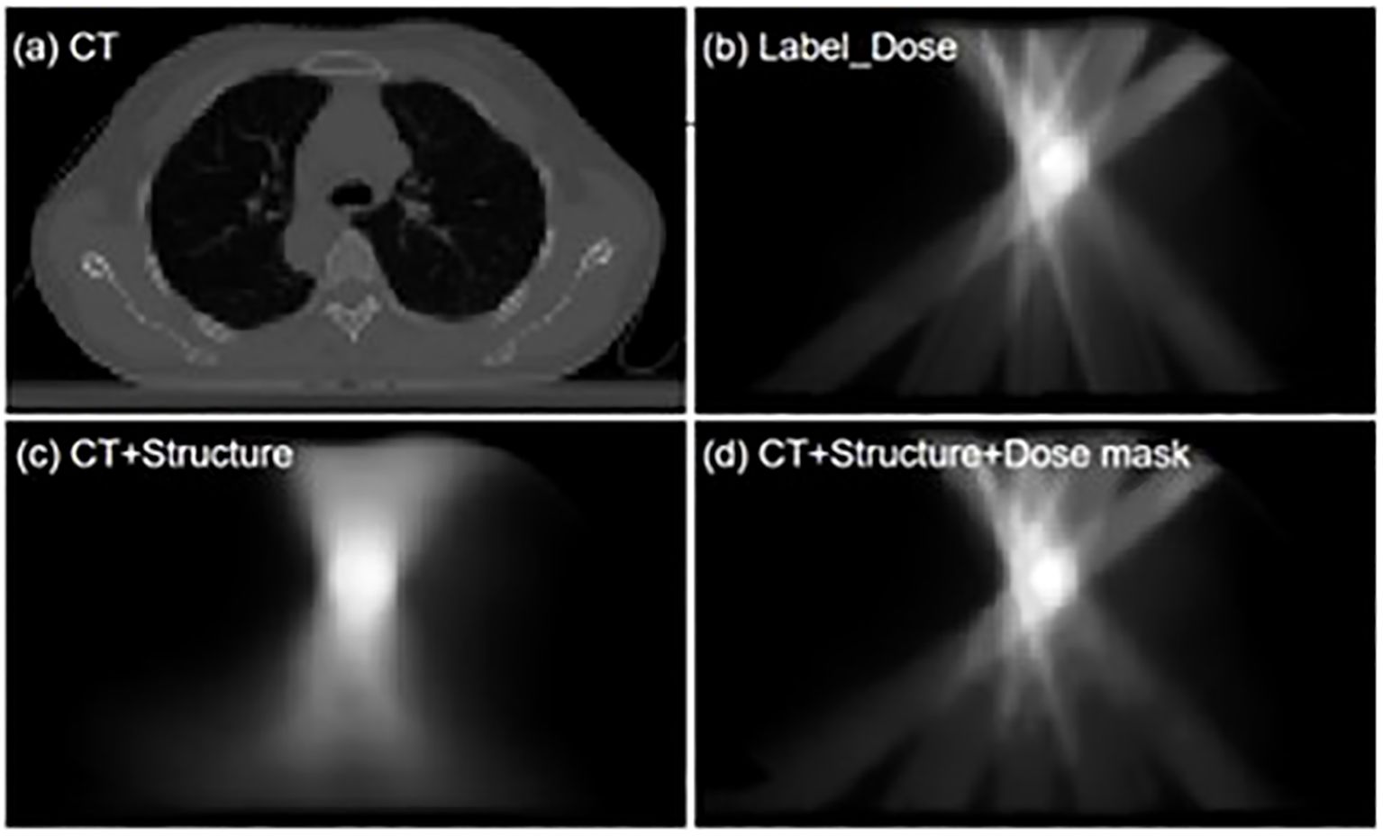 The four subfigures in Figure 1 demonstrate distinct information: (a) Transverse CT scan of the thorax; (b) Dose distribution map labeled 'Label_Dose' representing the clinical treatment plan's dose distribution; (c) 'CT+Structures' denotes the dose distribution prediction from a model using only these two input data types; (d) 'CT+Structures+Dose Mask' enhances dose distribution prediction accuracy by incorporating an additional dose mask input based on (c).