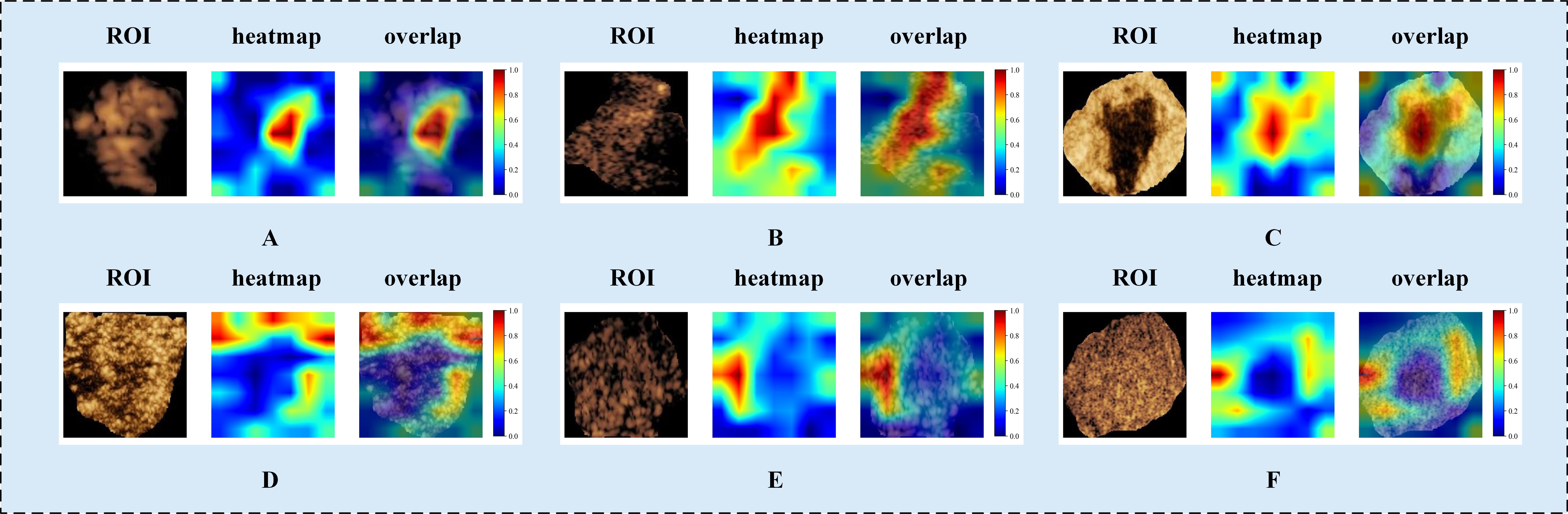 Six panels labeled A to F, each containing three images: an ROI, a heatmap, and an overlap of both. Each set highlights different data representations, with color scales ranging from blue to red indicating varying intensities.