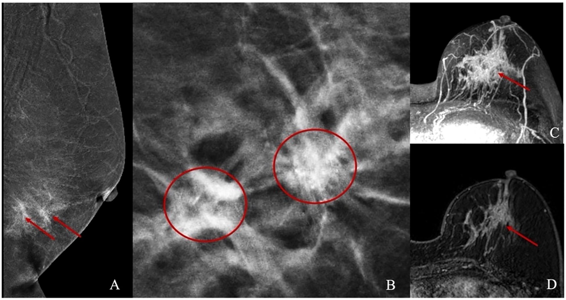 Panel A shows a mammogram with two arrows pointing to areas in the breast. Panel B reveals two circled regions of dense tissue. Panels C and D display MRI images with arrows indicating suspicious areas in the breast tissue.