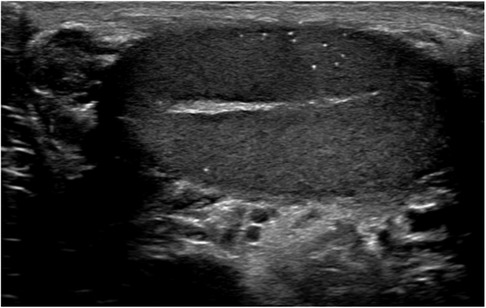 Ultrasound image showing a dark, rounded area with a bright horizontal line across the middle, with scattered white spots above the line. The surrounding tissue has a grainy appearance.