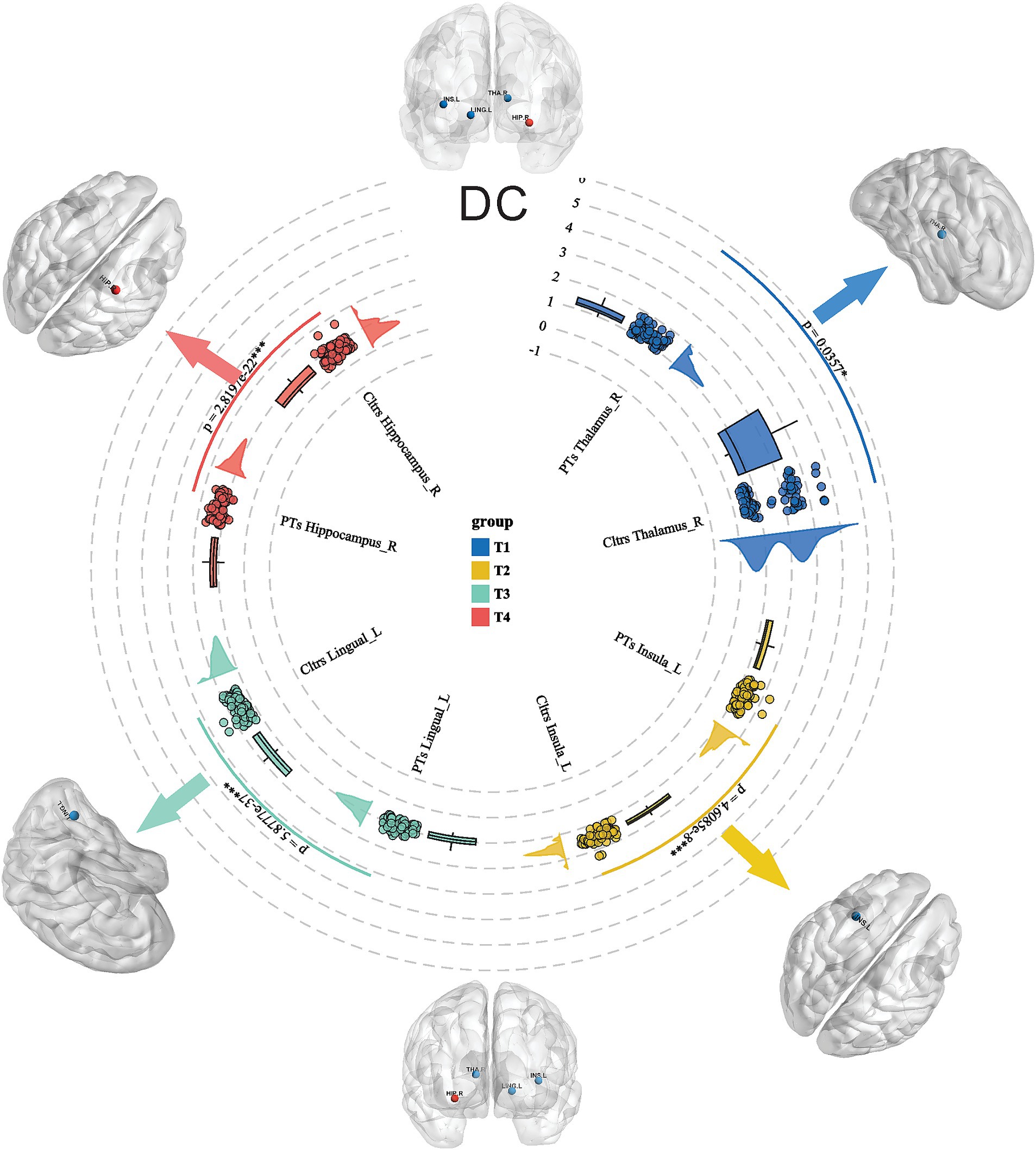 Diagram illustrating brain connectivity, featuring multiple brain models with highlighted areas. Circular data visualization represents four groups (T1 to T4) visualized in blue, green, yellow, and red. Arrows indicate significant differences, with values labeled.