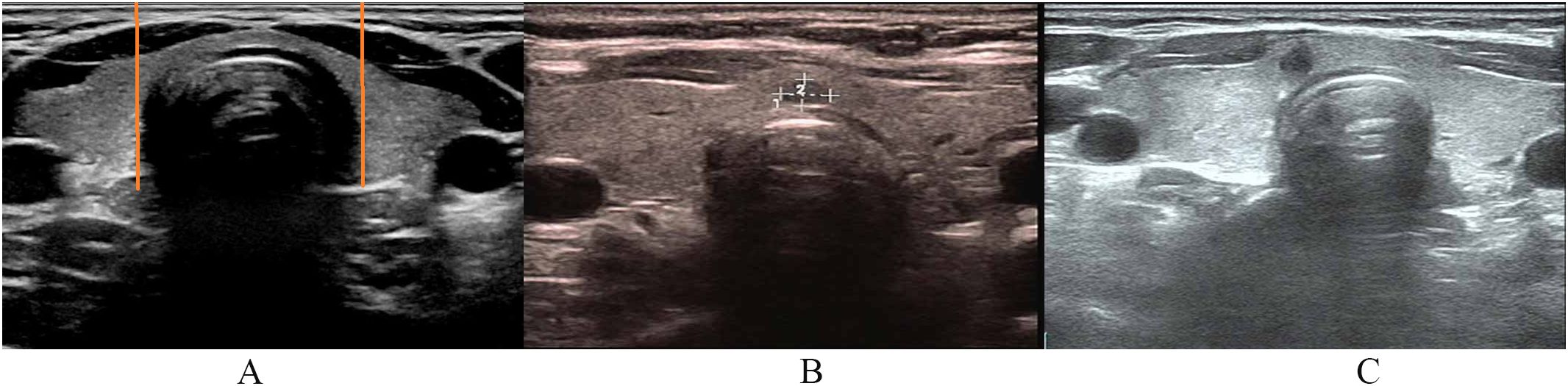 Three ultrasound images labeled A, B, and C show cross-sectional views of thyroid. Image A features orange lines marking the thyroid isthmic edges. Image B displays the lesion in thyroid central isthmus. Image C displays the lesion in the thyroid paracentral isthmus.