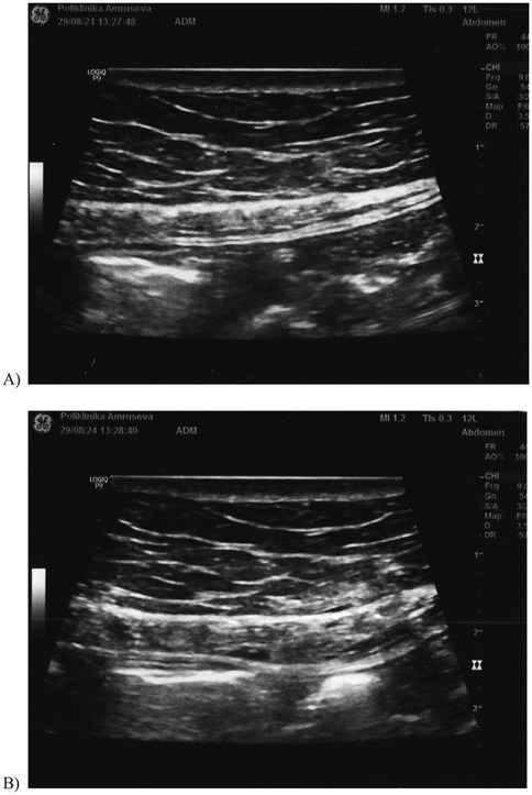 Ultrasound images labeled A and B, showing abdominal scans with varying shades of gray indicating different tissue densities. The structural patterns suggest layered tissues, typical in abdominal ultrasonography, with some variation between the two images.