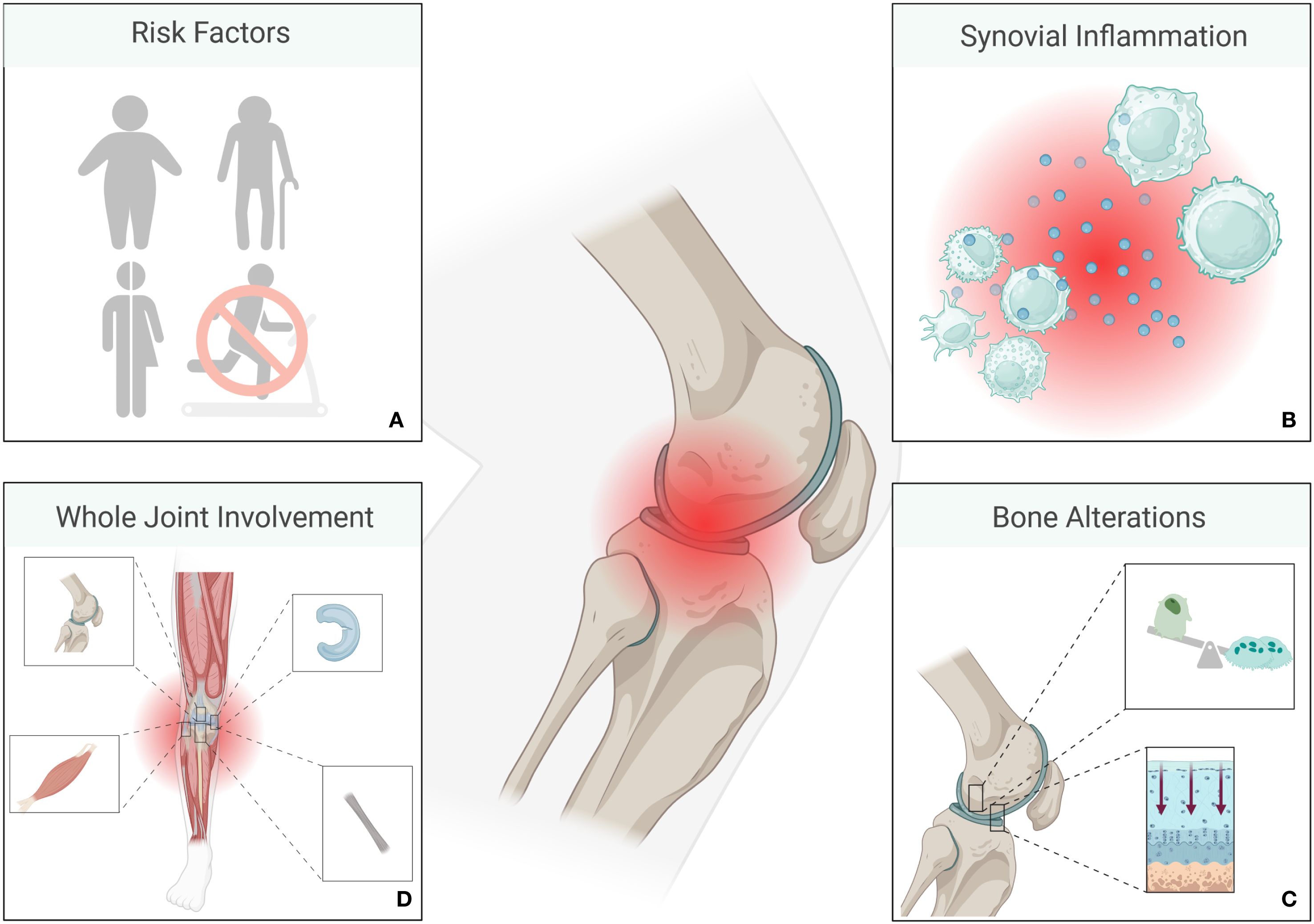 Illustration of factors contributing to joint inflammation. Panel A depicts risk factors, including obesity and sedentariness. Panel B shows synovial inflammation with immune cells. Panel C illustrates bone alterations with cellular processes. Panel D displays whole joint involvement, highlighting muscles, tendons, and cartilage. The central image of a knee joint shows redness indicating inflammation.
