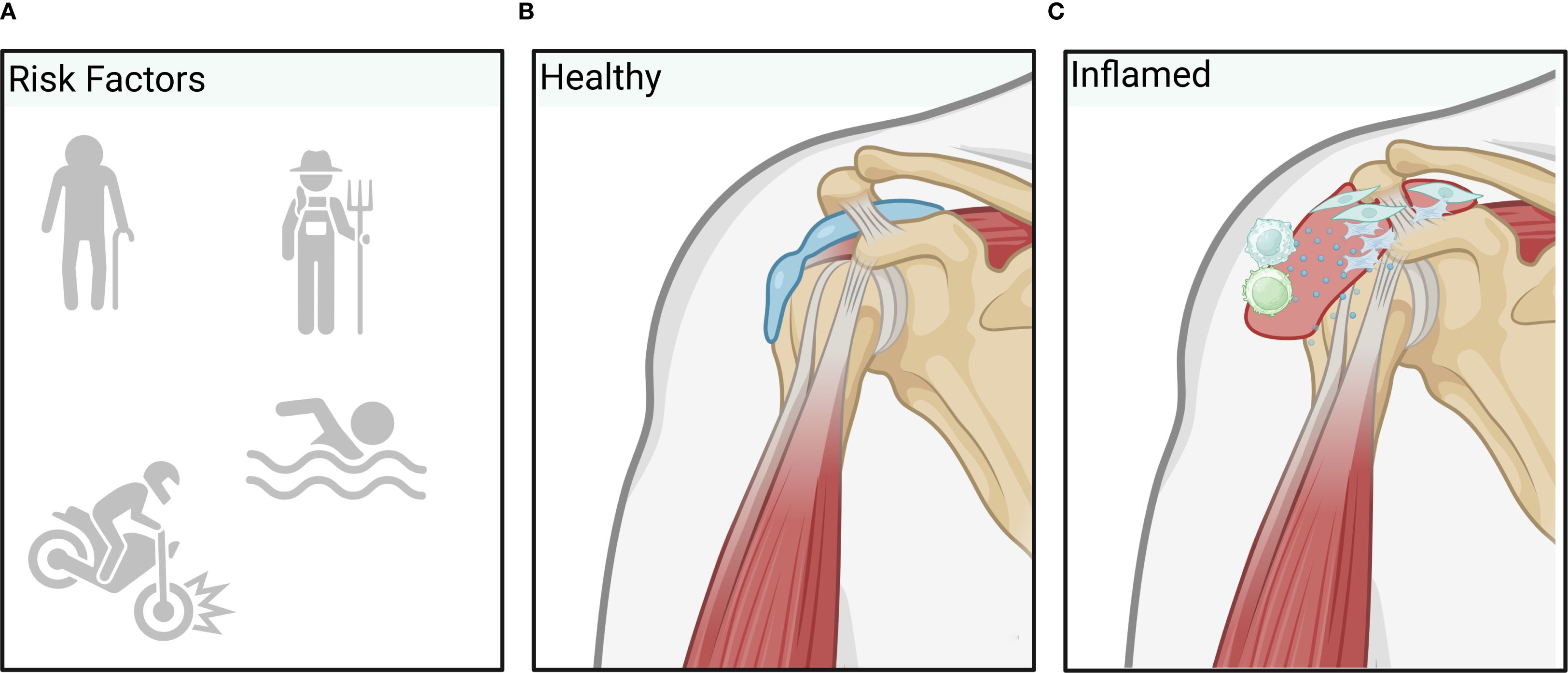 Panel A shows risk factors as icons: an elderly person, a farmer, a swimmer, and a person on a motorcycle. Panel B depicts a healthy shoulder joint with muscles, tendons, and a bursa. Panel C illustrates an inflamed shoulder with visible irritation and cellular activity.