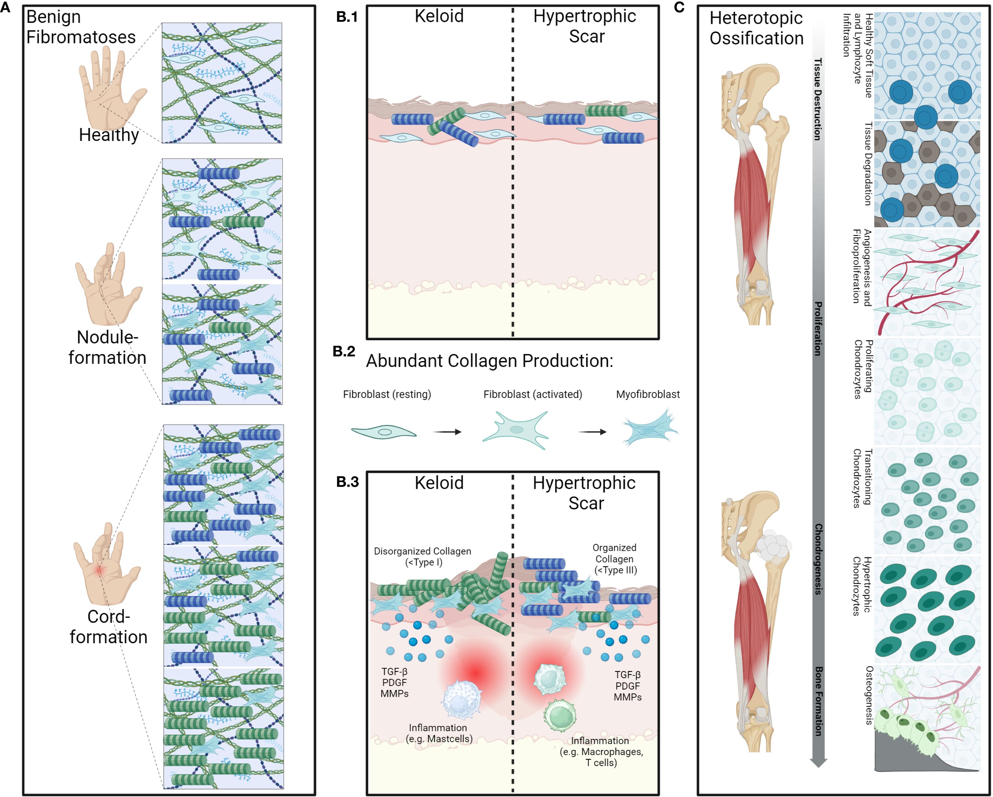 Diagram illustrating three panels: A, B, and C. Panel A shows stages of benign fibromatoses in hands: healthy, nodule-formation, and cord-formation, with collagen fiber illustrations. Panel B compares keloids and hypertrophic scars, showing skin layers, abundant collagen production, fibroblast activation, and collagen organization. Panel C depicts heterotopic ossification, illustrating healthy soft tissue, tissue destruction, proliferation, chondrogenesis, and bone formation phases with related cell types and structures.