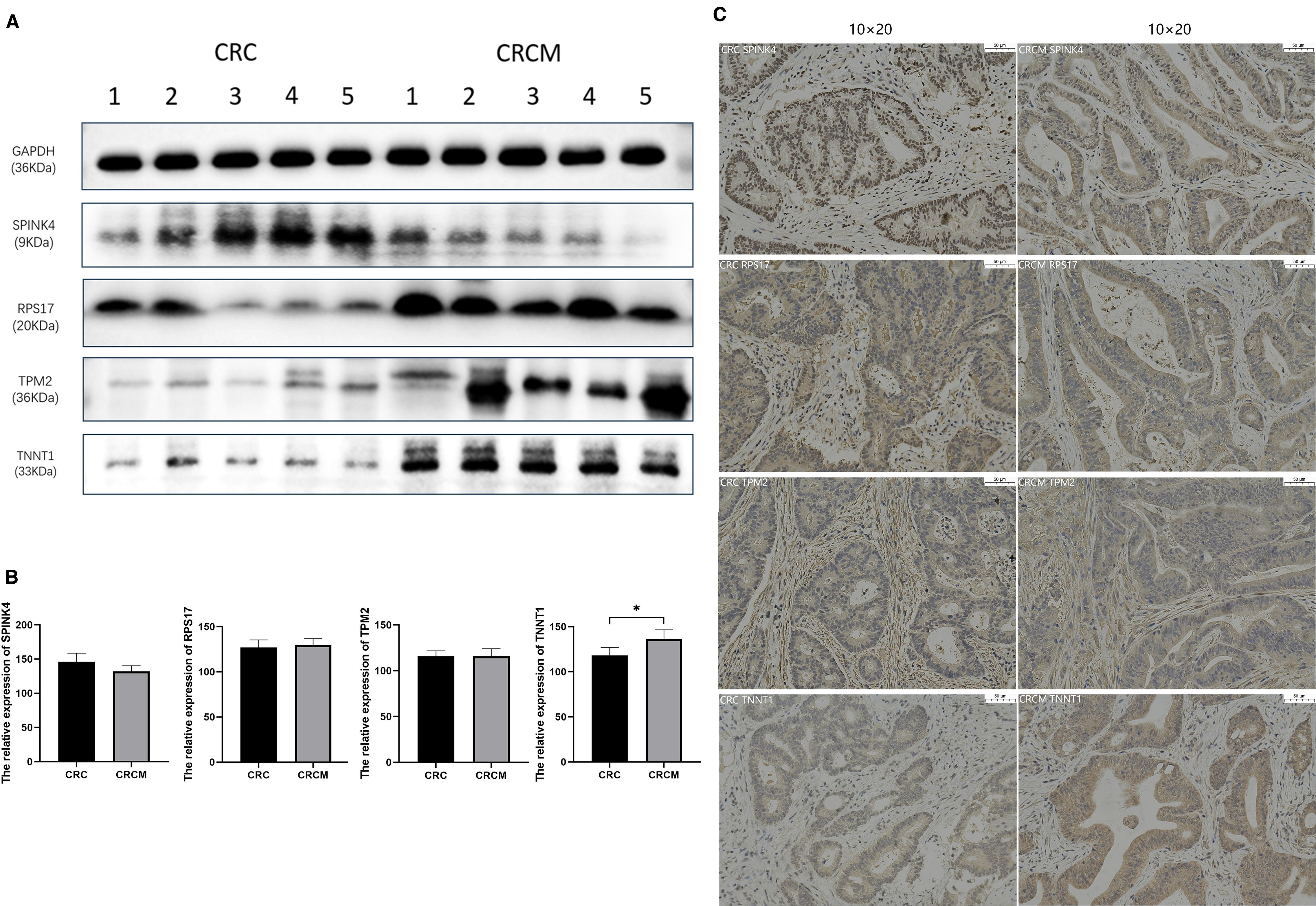 Three panels labeled A, B, and C. Panel A shows Western blot results for GAPDH, SPINK4, RPS17, TPM2, and TNNI1 across CRC and CRCM samples. Panel B displays bar graphs comparing the relative expression of SPINK4, RPS17, TPM2, and TNNI1 between CRC and CRCM, with a significant difference in TNNI1. Panel C includes immunohistochemistry images for SPINK4, RPS17, and TPM2 in CRC and CRCM tissues, magnified at ten by twenty.