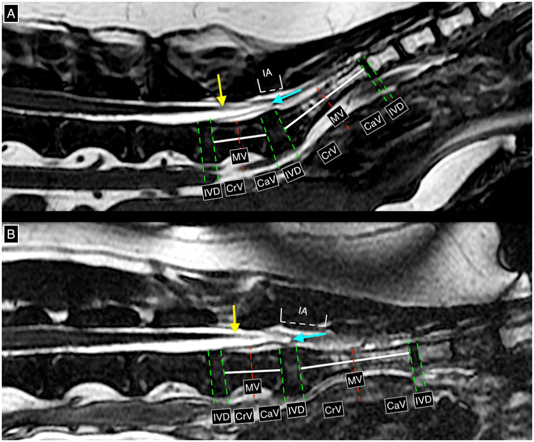 Mid-sagittal T2-weighted 3D FIESTA MRI images of the lumbosacral spine in neutral and flexed positions, showing the conus medullaris terminating at cranial L7 (yellow arrow) and the dural sac ending at the L7-S1 intervertebral disc space (light blue arrow). Colored lines mark vertebral endplates and measurement points.