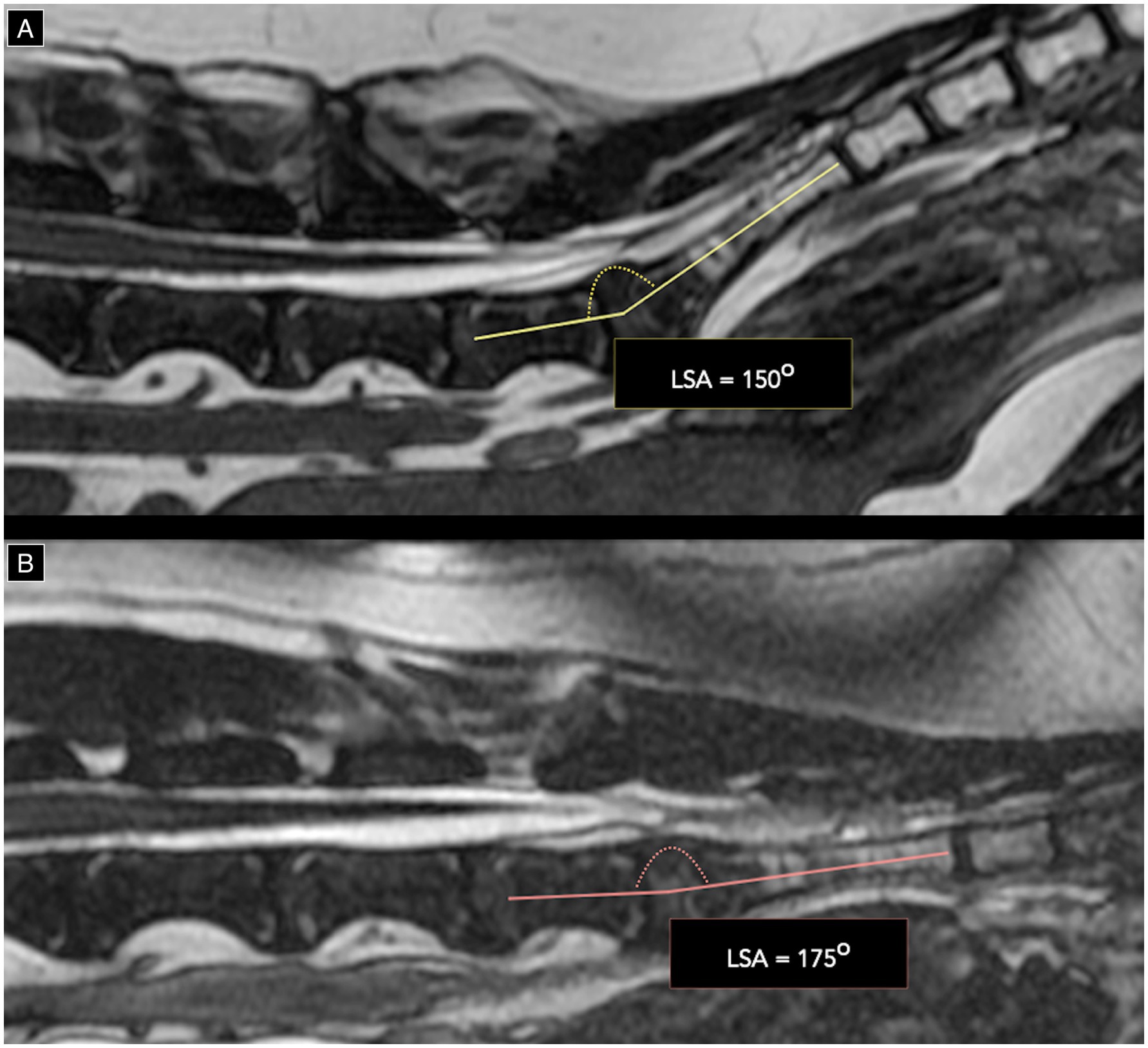 Mid-sagittal T2-weighted 3D FIESTA MRI images of the lumbosacral junction in neutral and flexed positions, showing the lumbosacral angle increasing from 150° to 175° with flexion.