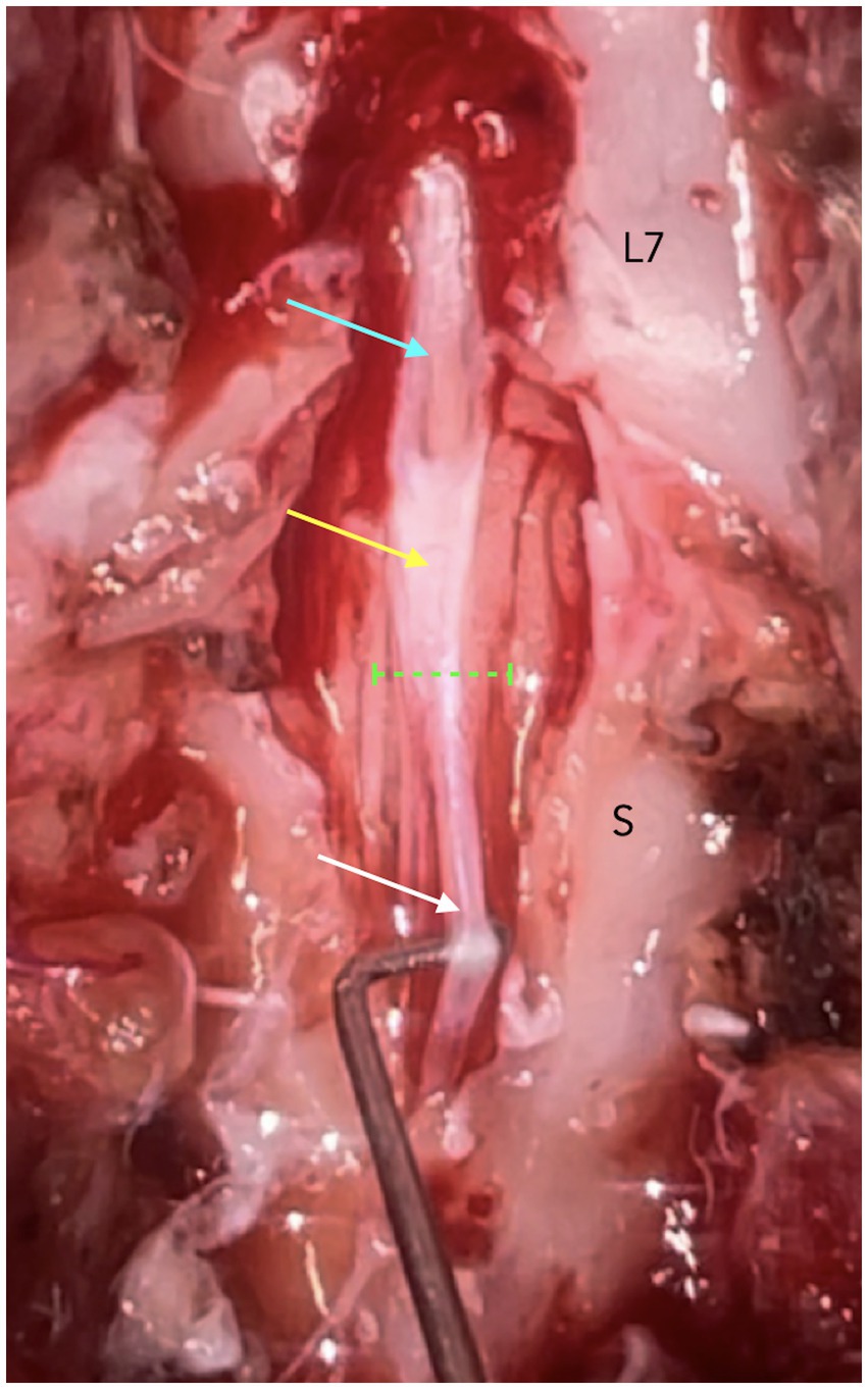 Close-up image of a dorsal laminectomy from L7 to S2 in a dog with C-OTCS, showing the dural sac (cyan arrow), thickened and opaque dura (yellow arrow) near the dural sac termination marked by an interrupted green line, and the filum terminale externum (white arrow).