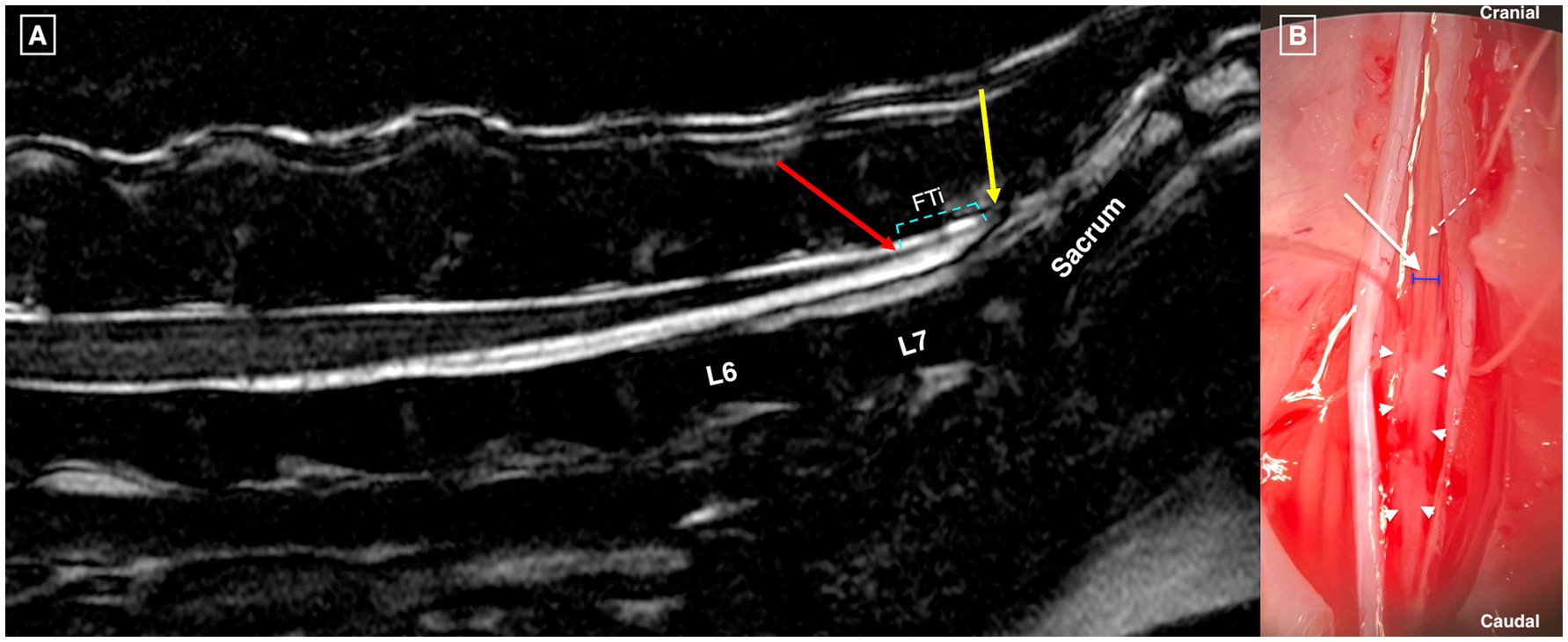 Mid-sagittal T2-weighted 3D FIESTA MRI of the caudal lumbar to cranial coccygeal spine in a dog with OTCS showing normal anatomy with the conus medullaris ending at mid-L7 (red arrow), dural sac ending at cranial sacrum (yellow arrow), and filum terminale internum outlined by cyan interrupted lines (A). Microsurgical dorsal view after L7-S2 laminectomy showing retracted dural edges, filum terminale internum (white arrow), its width (blue lines), dorsal spinal vein (interrupted white arrow), and abnormal infiltrative soft tissue adhering to the distal filum terminale (white arrowheads) extending to dural sac termination (B).