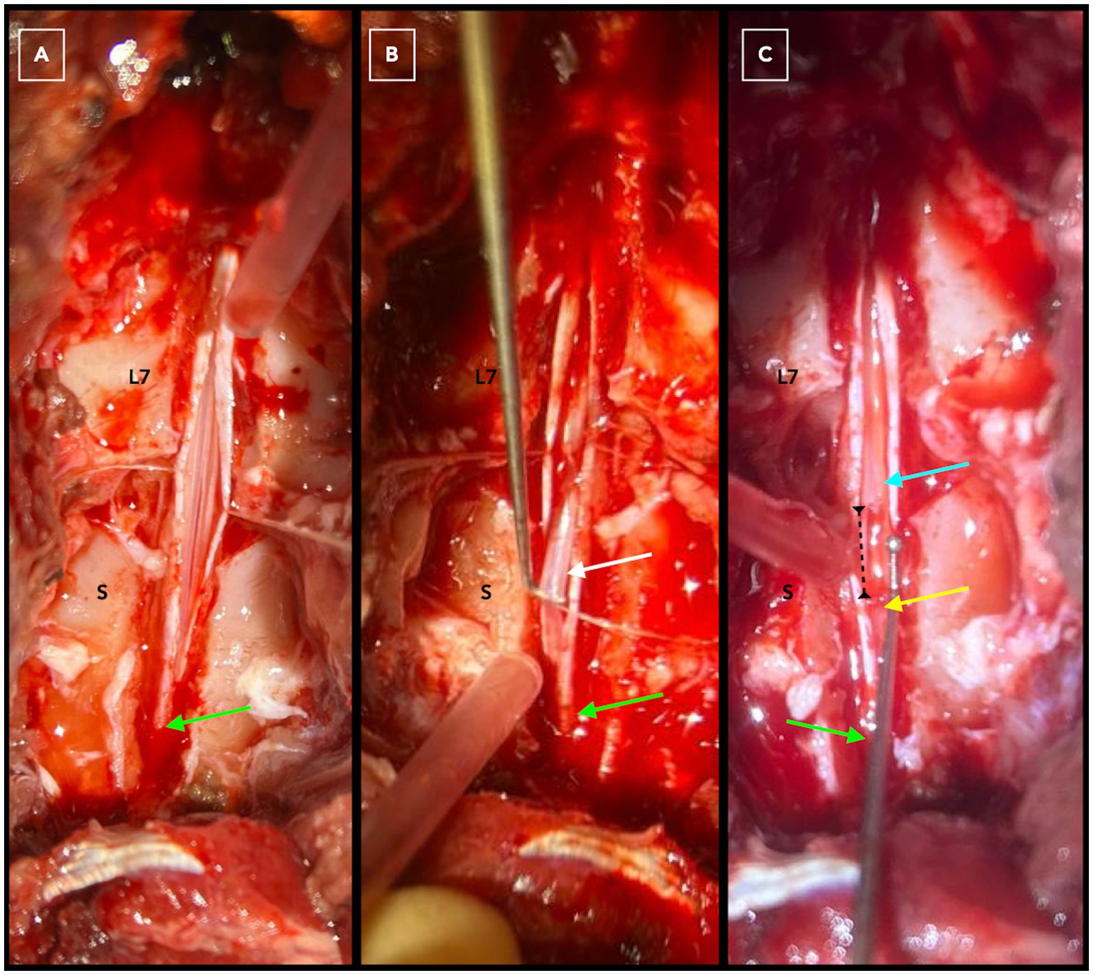 Dorsal laminectomy at L7-S3 with durotomy exposing intradural structures from cranial L7 to dural sac termination in the sacrum (green arrow) in a dog with C-OTCS (A). The filum terminale internum is indicated by a white arrow before (B) and after (C) dissection. The proximal filum terminale internum is marked by a cyan arrow, and the distal part by a yellow arrow. An interrupted black line shows the gap created by dissection and cranial movement of the conus medullaris.