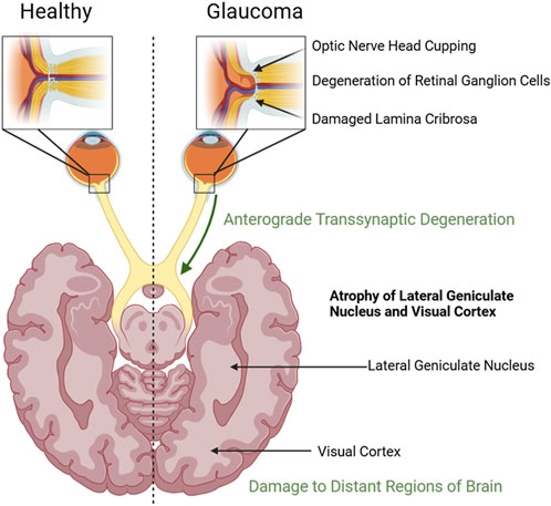 Diagram comparing healthy and glaucoma-affected eyes. On the left, a healthy optic nerve is shown without abnormalities. On the right, glaucoma is depicted with optic nerve head cupping, degeneration of retinal ganglion cells, and damaged lamina cribrosa. Below, anterograde transsynaptic degeneration leads to atrophy of the lateral geniculate nucleus and visual cortex, indicating damage to distant brain regions.