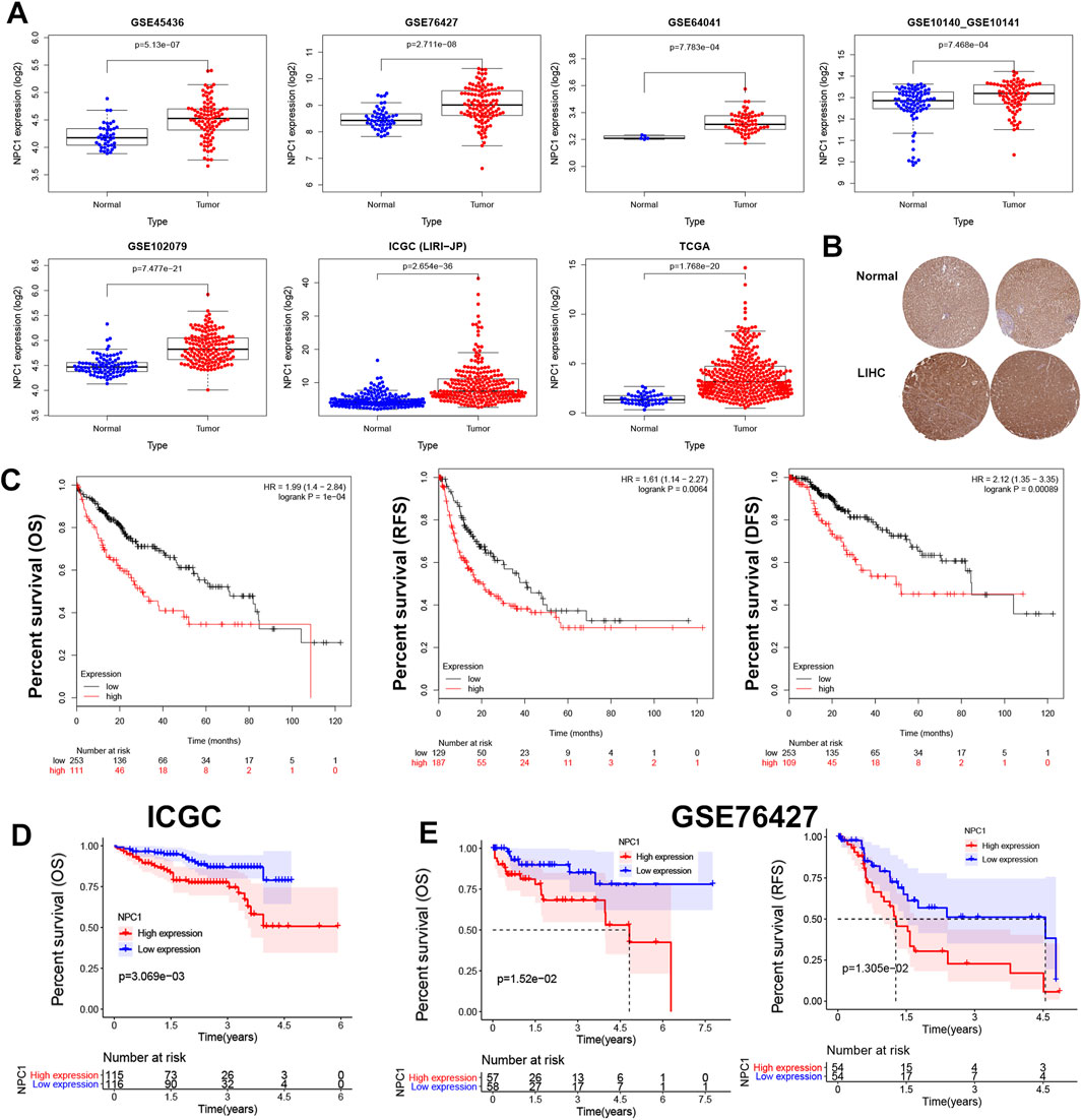 Graphical representation of cancer research data divided into panels A-E. Panel A shows box plots of NFIC1 expression in normal vs. tumor samples across various datasets. Panel B displays comparative histological images of normal and liver cancer tissues. Panel C presents survival curves (overall, relapse-free, disease-free) with high vs. low expression showing significant differences. Panel D shows the overall survival curve from ICGC data, while Panel E presents survival curves from GSE76427 data, highlighting differences in high vs. low NFIC1 expression groups. Statistical values and hazard ratios are included in each panel.
