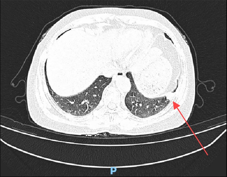 CT scan of the thorax showing the lungs. A red arrow points to an area on the right lung, highlighting a possible abnormality or region of interest for diagnosis.