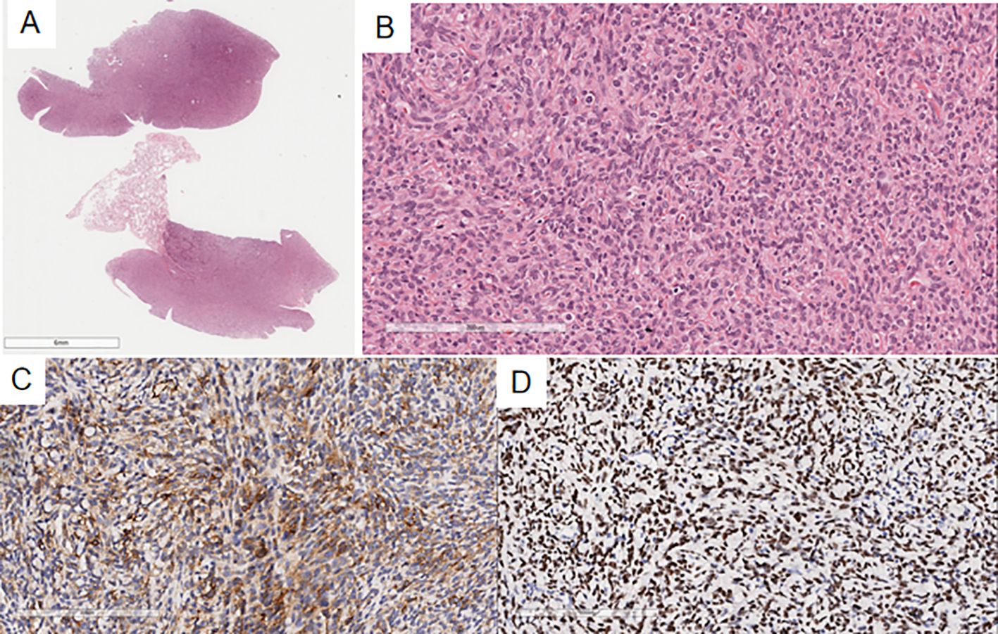 Panel A shows a low-magnification histopathological slide with large pink areas. Panel B depicts a high-magnification view of densely packed cells with a pink hue. Panel C features cells stained in a brownish color. Panel D displays a high concentration of small, dark-stained nuclei against a light background.