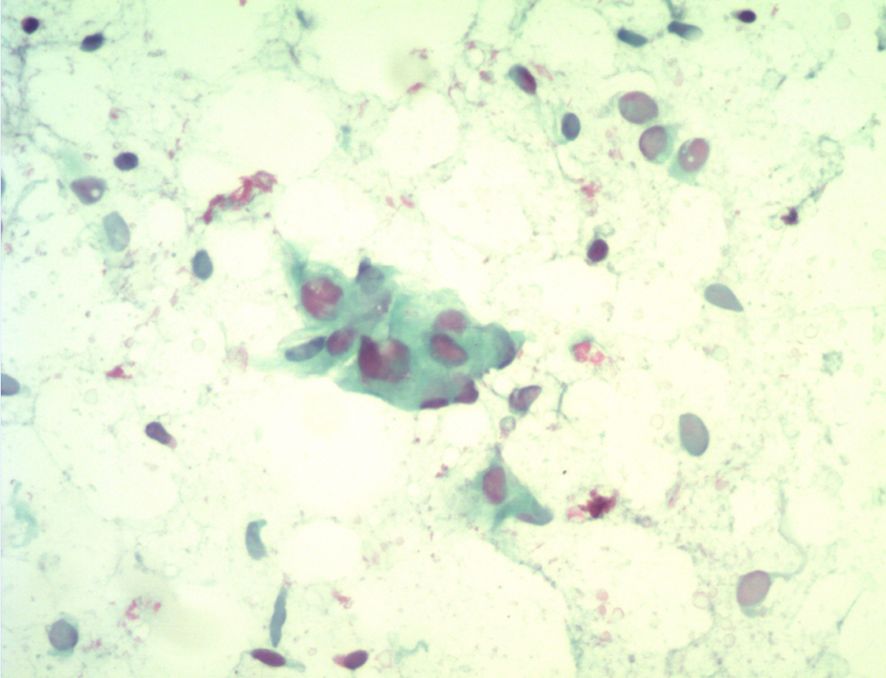 Microscopic view of cells from a fine needle aspirate of breast tissue, showing foam cells and multinucleated giant cells indicative of fat necrosis. The background is a pale staining matrix.