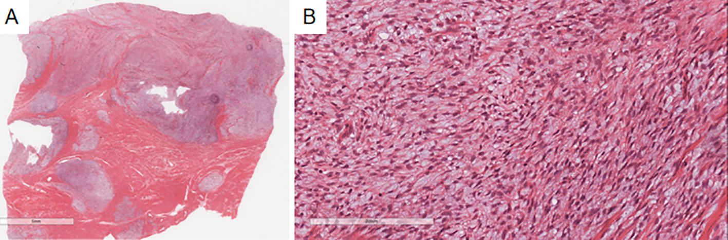 Panel A shows a low magnification view of a histological tissue section stained with hematoxylin and eosin, displaying a mix of pink and purple regions indicating different tissue types. Panel B presents a higher magnification of the same type of tissue, revealing a dense arrangement of elongated cells with visible nuclei, characteristic of fibrous or muscular tissue.
