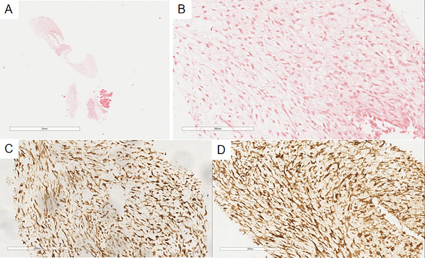 A set of four histological images labeled A through D. Image A shows a sparse distribution of pink-stained cells. Image B presents a denser area of pink-stained cells with a more fibrous appearance. Images C and D display brown-stained cells densely packed, with varying levels of cell concentration and clarity. Each image features a scale bar at the bottom for reference.