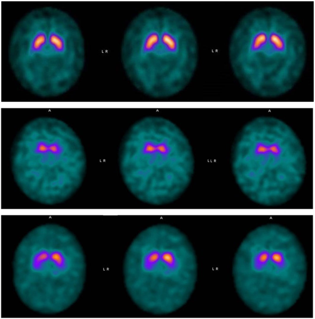 Three rows of brain scan images show different views and color intensities, likely representing regions of activity or health. Each row contains three images with marked sections labeled L and R for left and right.