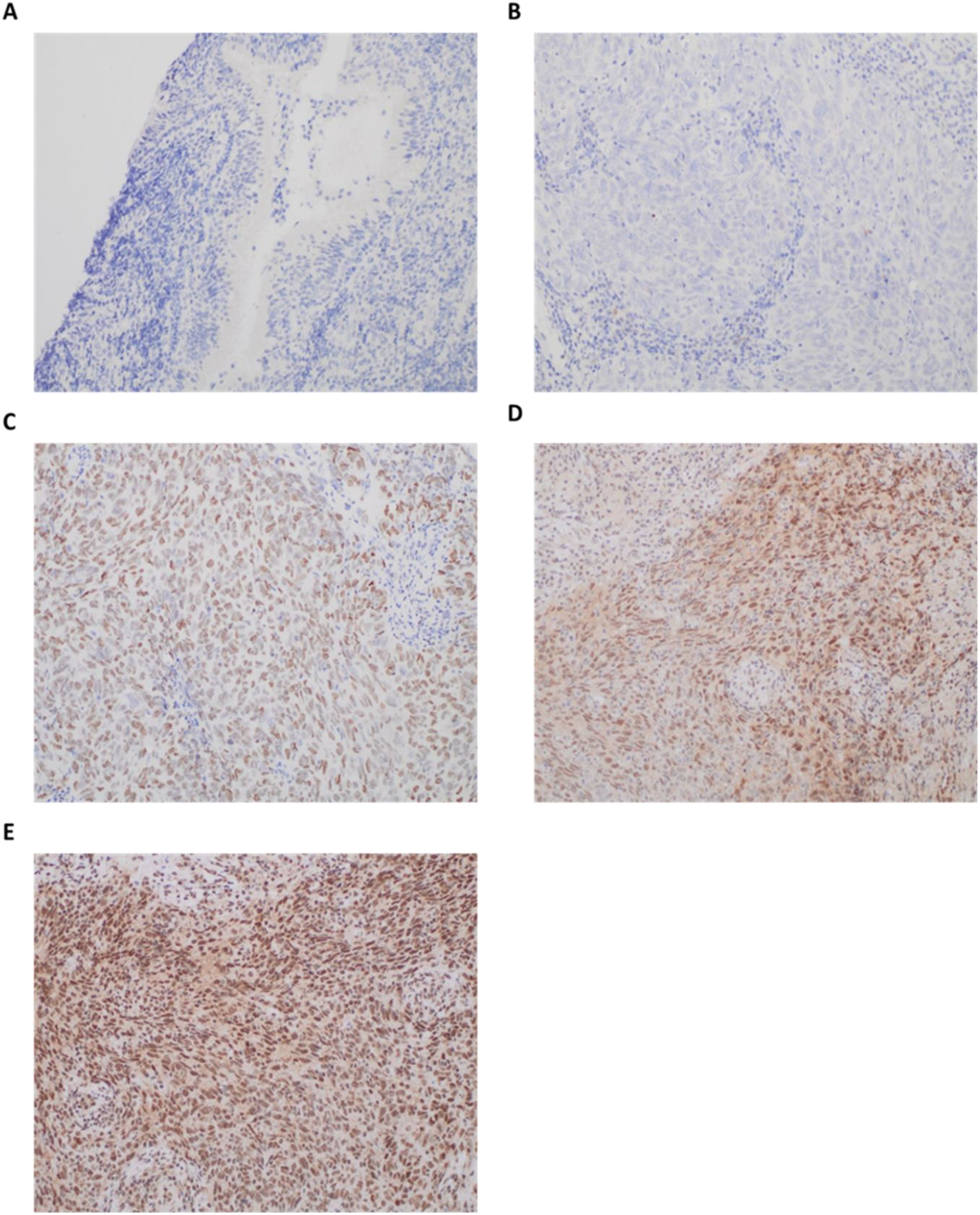 Histological images labeled A to E show tissue samples with varying levels of staining. Image A and B depict lighter staining, indicating lower protein expression. Images C, D, and E show progressively darker staining, suggesting increased protein expression across the samples.