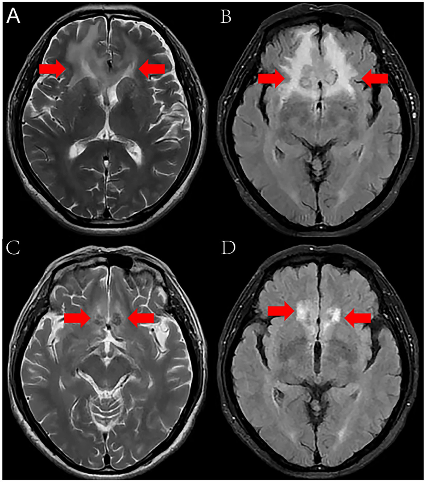 MRI scans showing four axial images labeled A, B, C, and D. Each image has red arrows pointing at specific areas within the brain. These arrows likely highlight regions of interest or abnormality for medical analysis.
