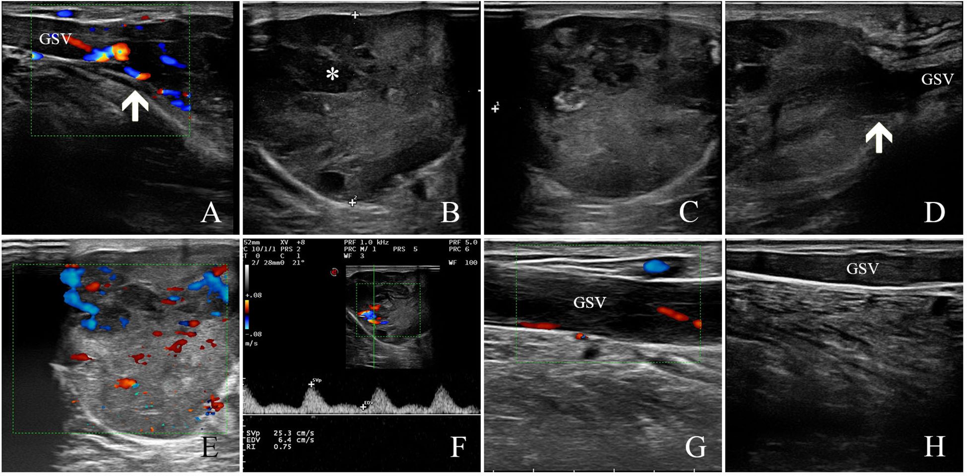 Ultrasound images labeled A to H showing various views of a vein. Color Doppler signals in images A, E, and G indicate blood flow, with red and blue signals visible. Panels D and H are labeled with “GSV” for the great saphenous vein. An arrow and an asterisk highlight specific areas in images A, B, and D. Panel F includes velocity and intensity graphs.