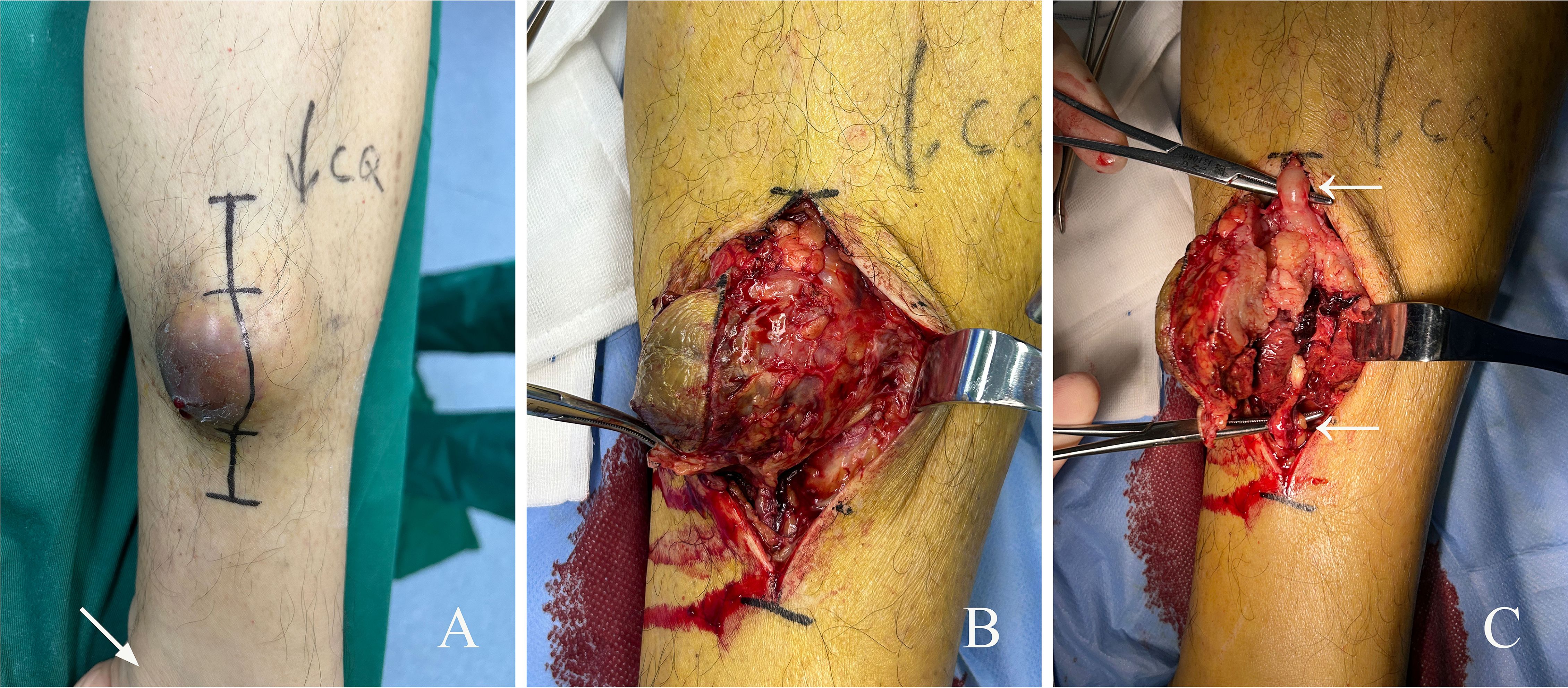 Panel A shows a leg with a marked line over a prominent mass. Panel B reveals the leg after surgical incision, exposing the mass surrounded by tissue. Panel C shows further surgical exposure with arrows indicating specific areas of interest.