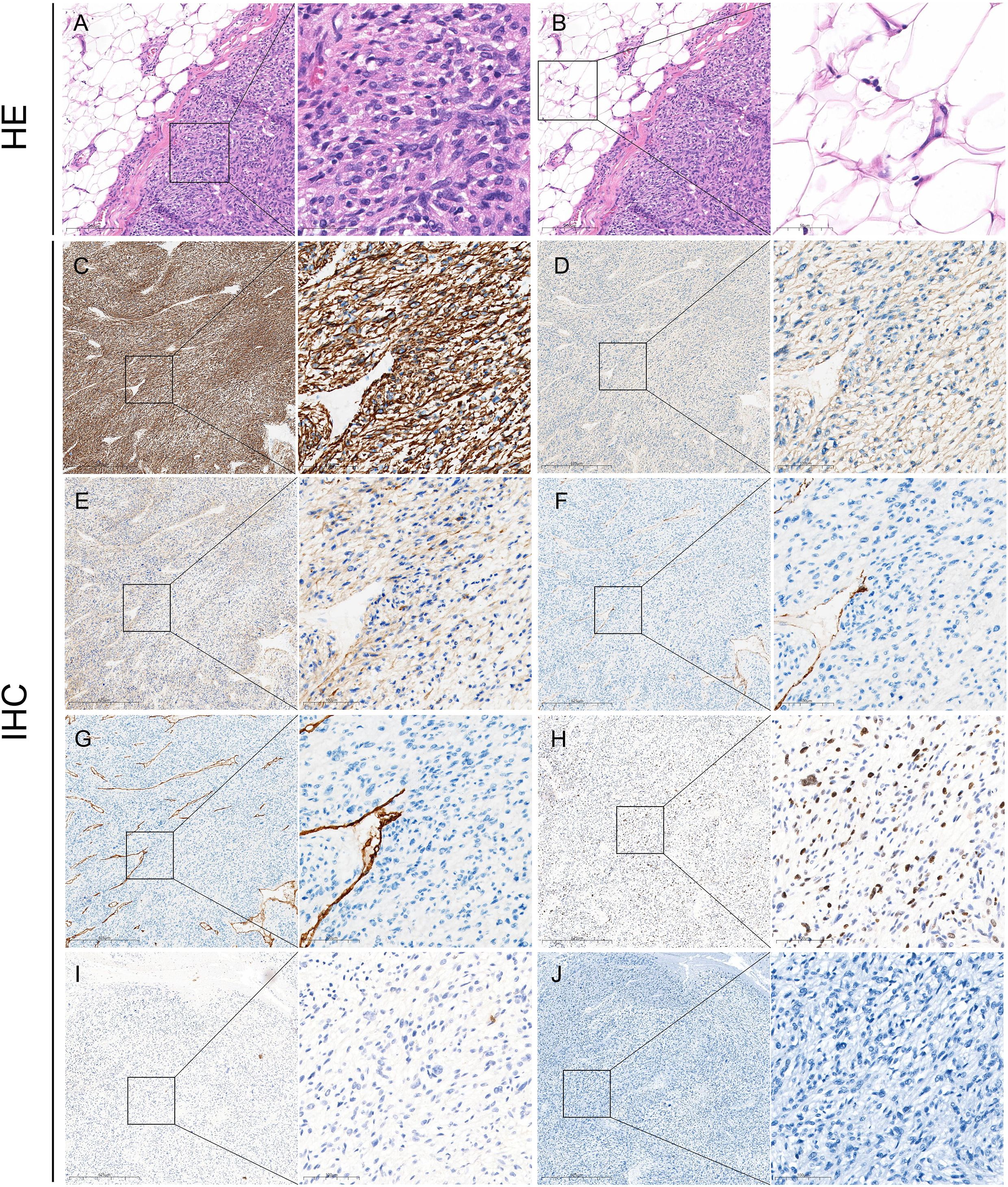Histological image panel showing HE and IHC stained tissue samples. Panels A and B depict HE staining with purple and pink hues, highlighting cellular structures. Panels C to J show IHC staining, with varying levels of brown color indicating different marker expressions. Each section has a magnified inset to display cellular detail and tissue morphology.