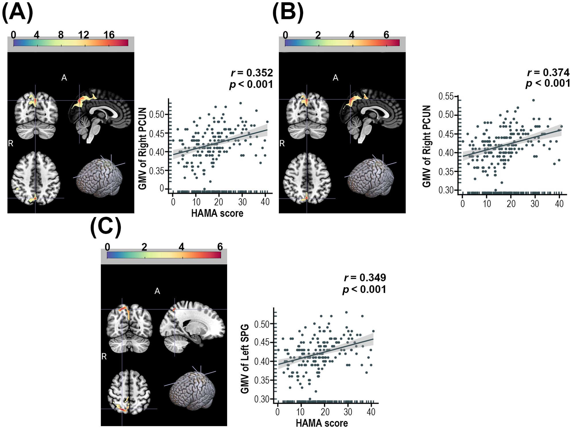 Brain imaging study with three panels (A, B, C) displaying brain scans and corresponding scatter plots. Each panel has MRI images highlighting brain areas with color scales that represent statistical values. The MRI images depict group differences: Panel A shows differences from a three-group chi-square comparison, Panel B shows differences between AD and NAD groups, and Panel C shows differences between AD and HC groups. Scatter plots plot GMV against HAMA scores, showing significant positive correlations. Panel A: Right PCUN (r=0.352, p <0.001). Panel B: Right PCUN (r=0.374, p<0.001). Panel C: Left SPG (r=0.349, p<0.001)