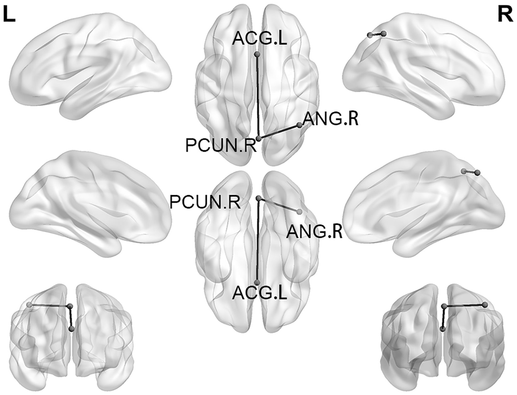 Diagram of brain models showing SC connections between specific regions. Lateral views on the left and right, with top and rear views at the bottom. Labels indicate connections: ACG.L to PCUN.R and ANG.R, and PCUN.R to ANG.R. The left and right hemispheres are marked with “L” and “R.