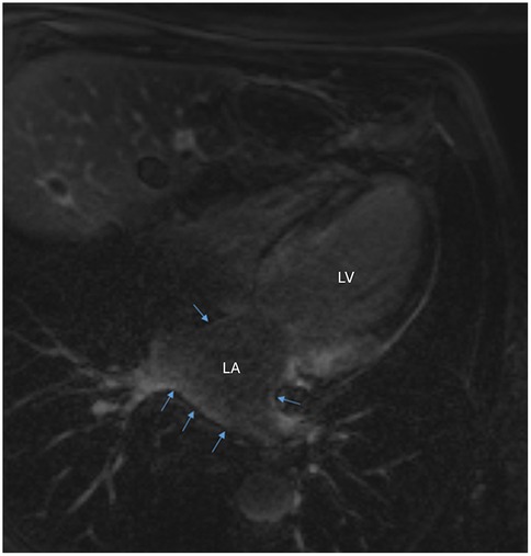 MRI scan of the heart showing the left atrium (LA) and left ventricle (LV). Blue arrows point to specific regions around the left atrium, focusing on potential abnormalities or findings.
