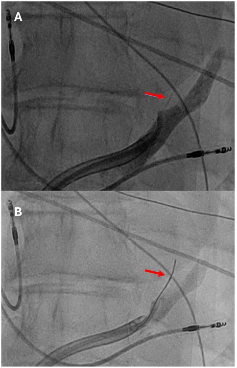 Angiographic images showing two panels labeled A and B. In panel A, a red arrow indicates a narrowing in a blood vessel, possibly an area of stenosis. Panel B shows the same area after intervention; the red arrow highlights a smoother, wider vessel, suggesting successful treatment.