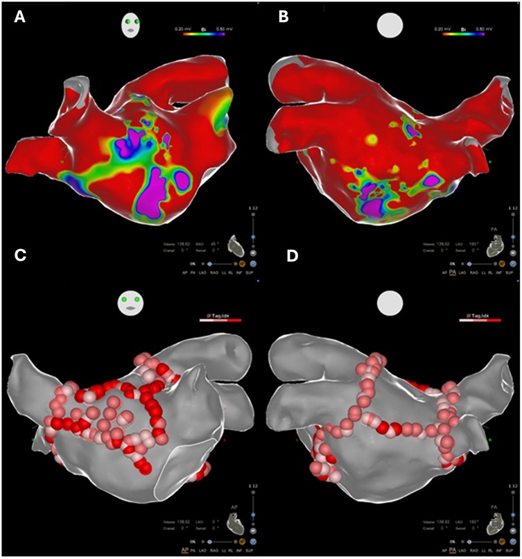 Four-panel medical illustration showing 3D heart models. Panels A and B display color-coded voltage maps with red indicating high voltage and blue/purple indicating low voltage. Panels C and D show the same heart with red spheres marking ablation sites over the grey cardiac tissue surface. Tools and scale bars for reference are visible in each panel.