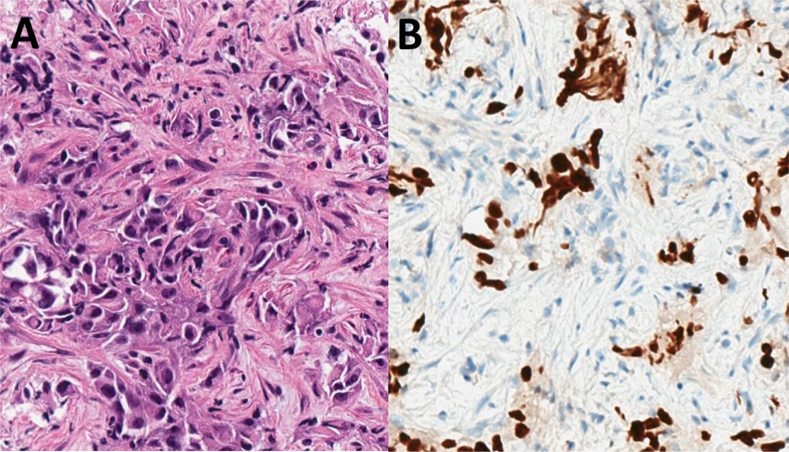 Panel A shows a histological image with densely packed cells stained in shades of purple and pink, indicating tissue structure. Panel B displays a similar histological image with cells stained in brown against a lighter background, highlighting different cellular components or protein expressions.
