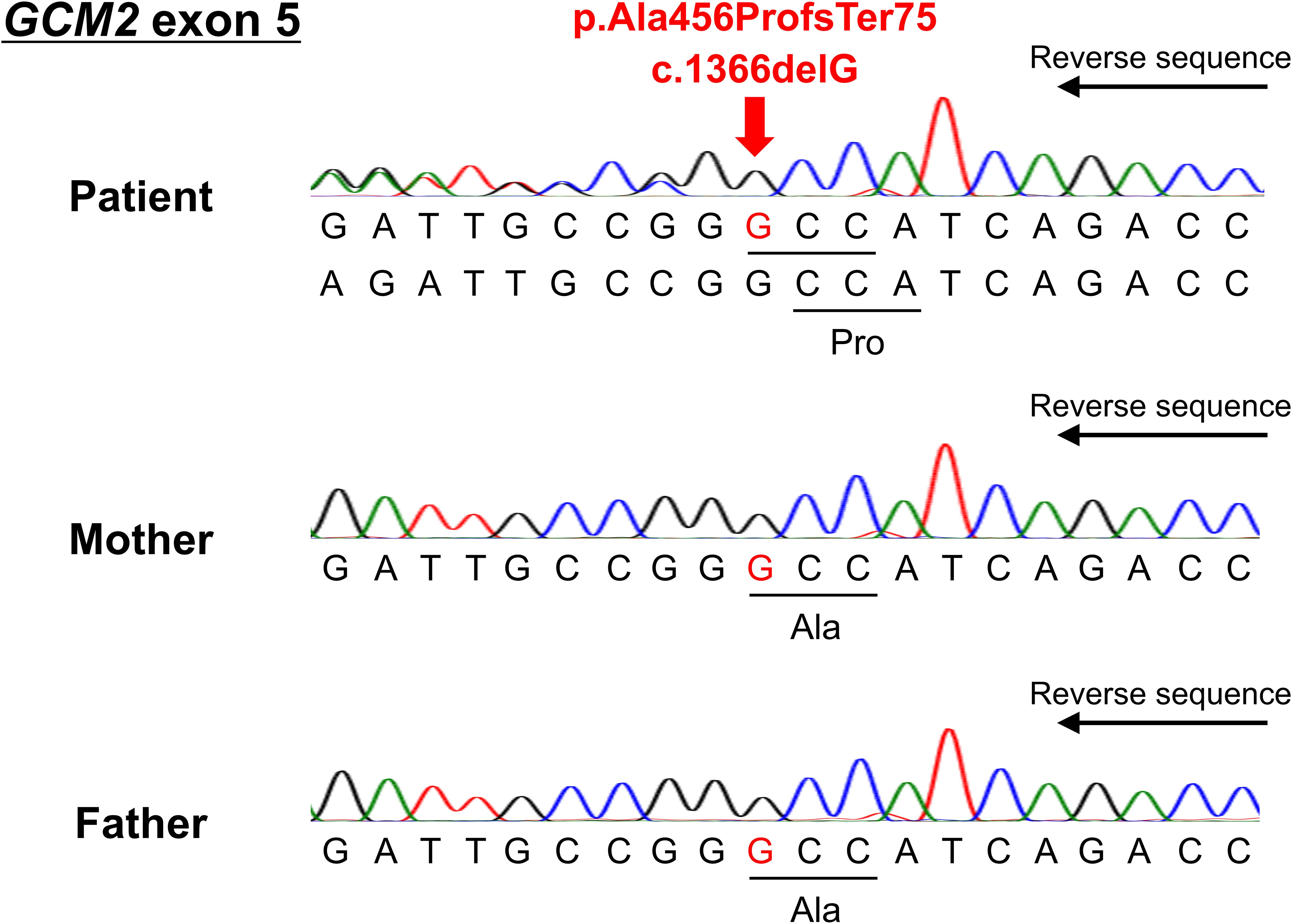 DNA sequencing electropherograms for GCM2 exon 5 show reverse sequences for a patient, mother, and father. The patient has a c.1366delG mutation indicated by a red arrow and marked as p.Ala456ProfsTer75. The nucleotide sequence below displays alterations in the patient, with “Pro” denoted. The mother and father sequences show the nucleotide “Ala” intact.