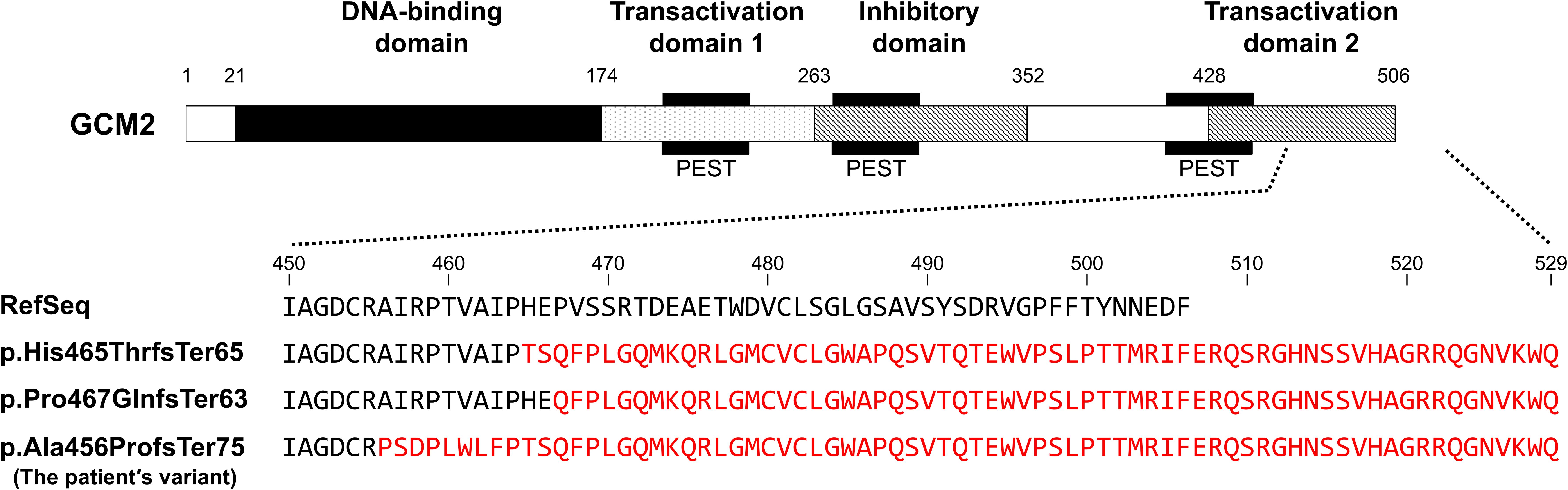 Diagram illustrating the GCM2 protein structure, highlighting domains: DNA-binding, transactivation (1 and 2), and inhibitory. Sequences for RefSeq, His465ThrfsTer65, Pro467GlnfsTer63, and patient's variant Ala456ProfsTer75 are shown, with alterations in red.