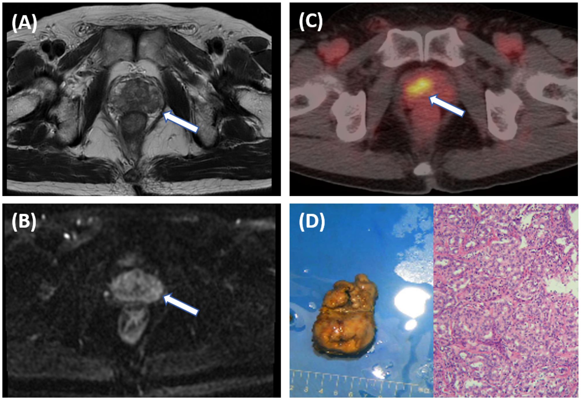 Four-panel image of medical diagnostics. (A) MRI scan shows an abnormality in the prostate, indicated by an arrow. (B) Diffusion-weighted MRI highlights the same area. (C) PET/CT scan reveals increased uptake in the prostate region. (D) Gross pathology specimen of prostate tissue and corresponding histology slide showing tissue structure.