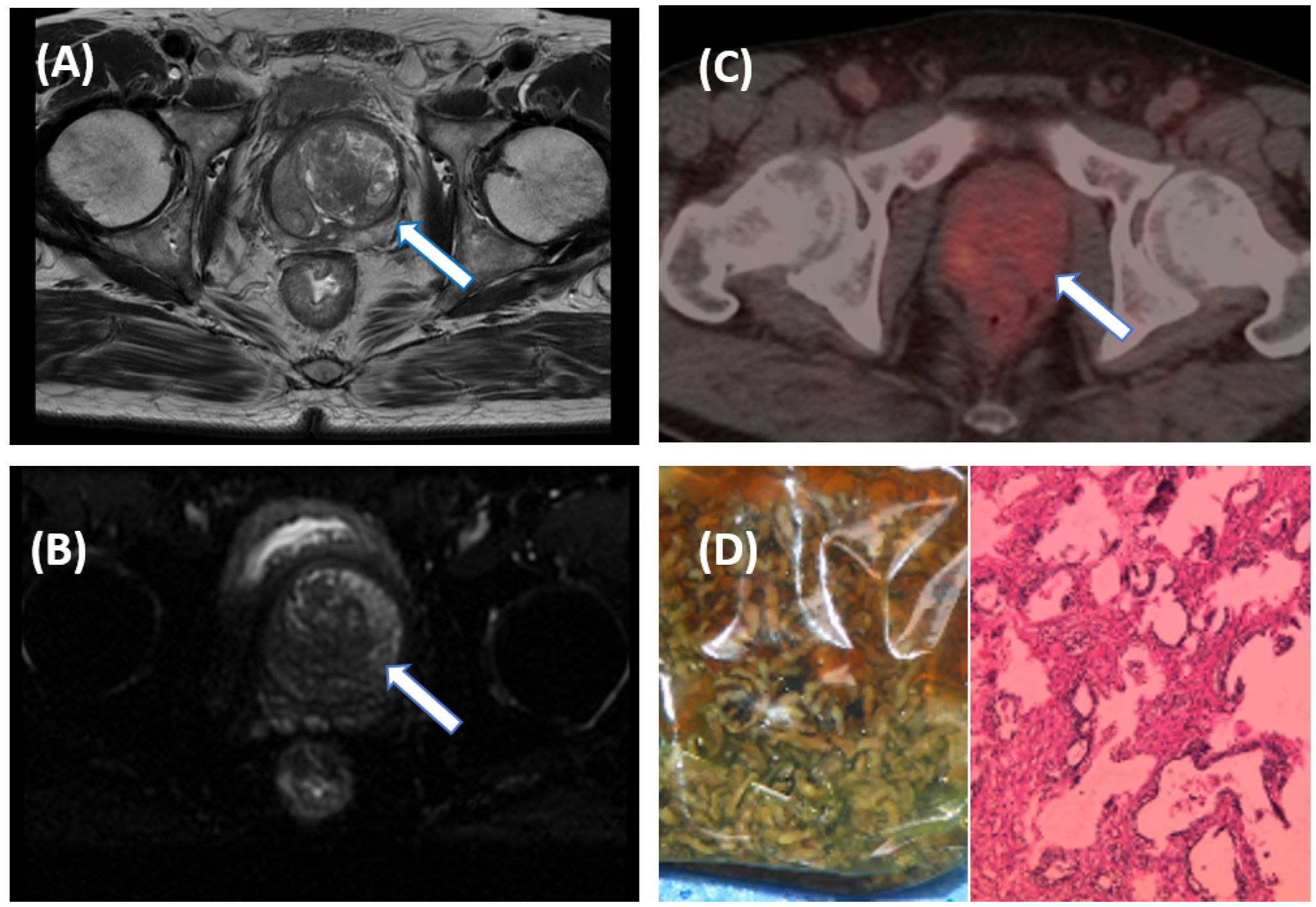 (A) MRI scan showing a pelvic mass indicated by an arrow. (B) Another MRI view highlighting the mass. (C) PET/CT scan displaying increased uptake in the pelvic area with an arrow pointing to it. (D) Gross pathology of the resected tumor on the left and microscopic view of the tumor cells on the right.