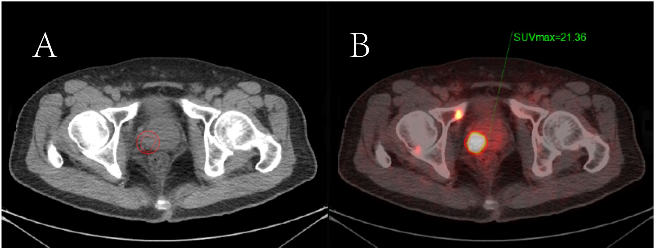 CT scan images side by side. Image A shows a cross-section of the pelvic area with a red circle indicating a specific region. Image B highlights this region with bright coloring, showing increased activity, and indicates a maximum standardized uptake value (SUVmax) of 21.36.